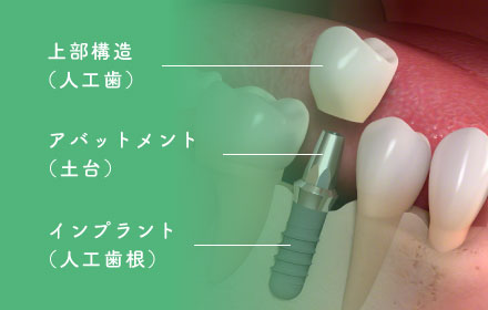 上部構造（人工歯）/アパットメント（土台）/インプラント（人工歯根）