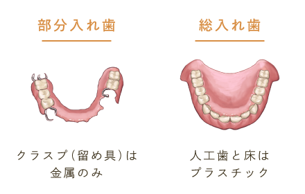 部分入れ歯：クラスプ（留め具）は金属のみ/総入れ歯：人工歯と床はプラスチック